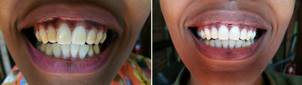 Before and after smile improvement at La Bouche Dental Clinic