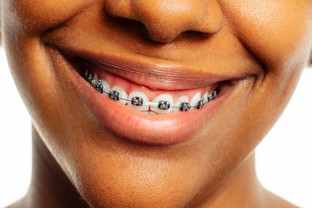 Patient wearing braces for teeth alignment at La Bouche Dental Clinic